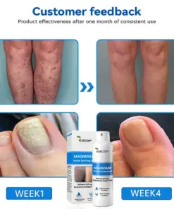 KUBOZN® Magnesium Herbal Psoriasis Spray