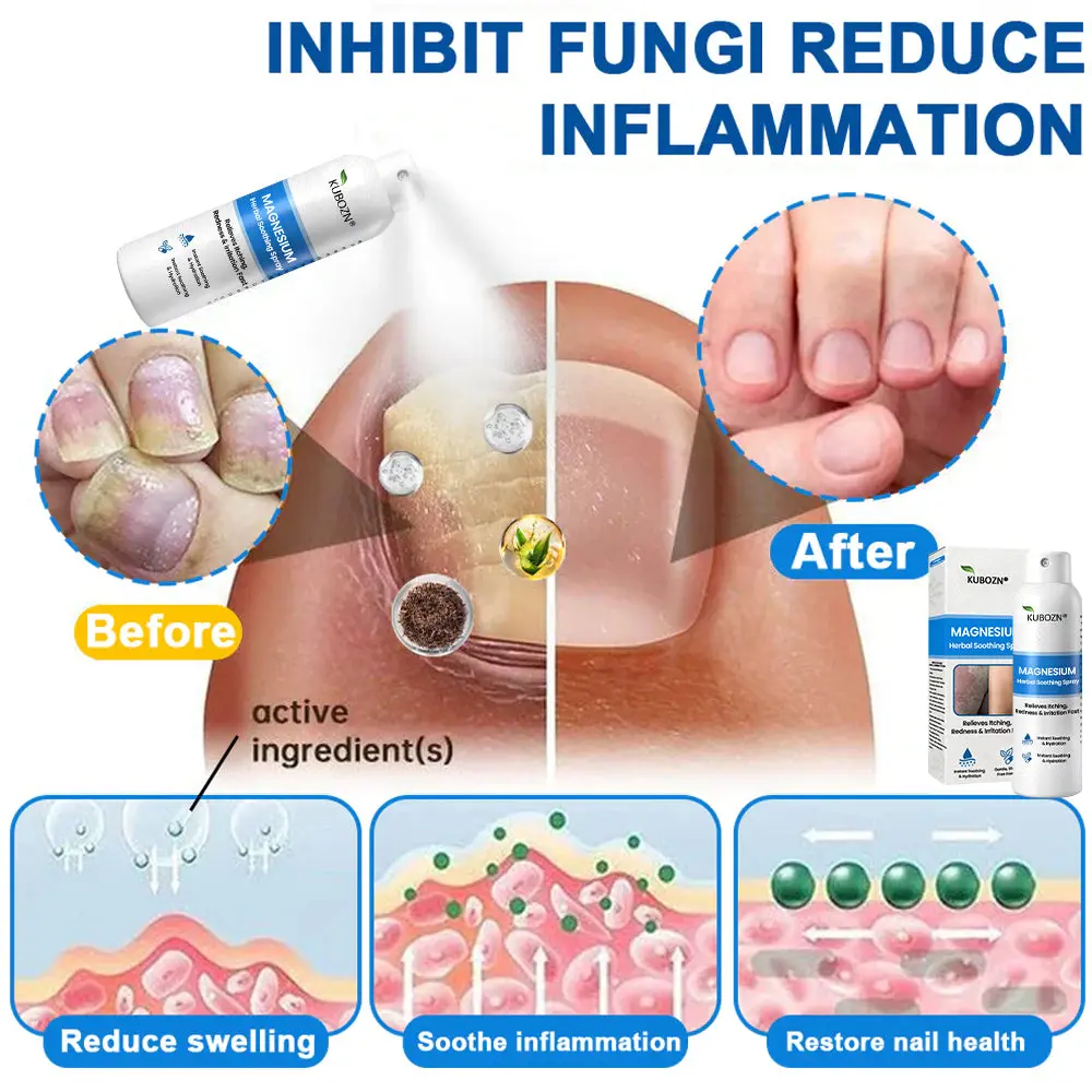 KUBOZN® Magnesium Herbal Psoriasis Spray