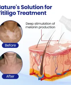 KUBOZN® Vitiligo Repigmentation Spray