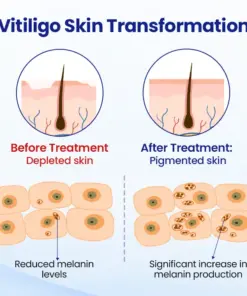 KUBOZN®Vitiligo Treatment Spray