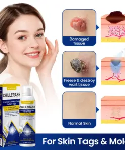 KUBOZN® ChillErase Cooling Spray for Skin Tags