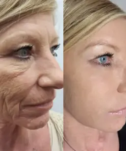 KUBOZN® GHK-Cu Microneedle Facial Patches