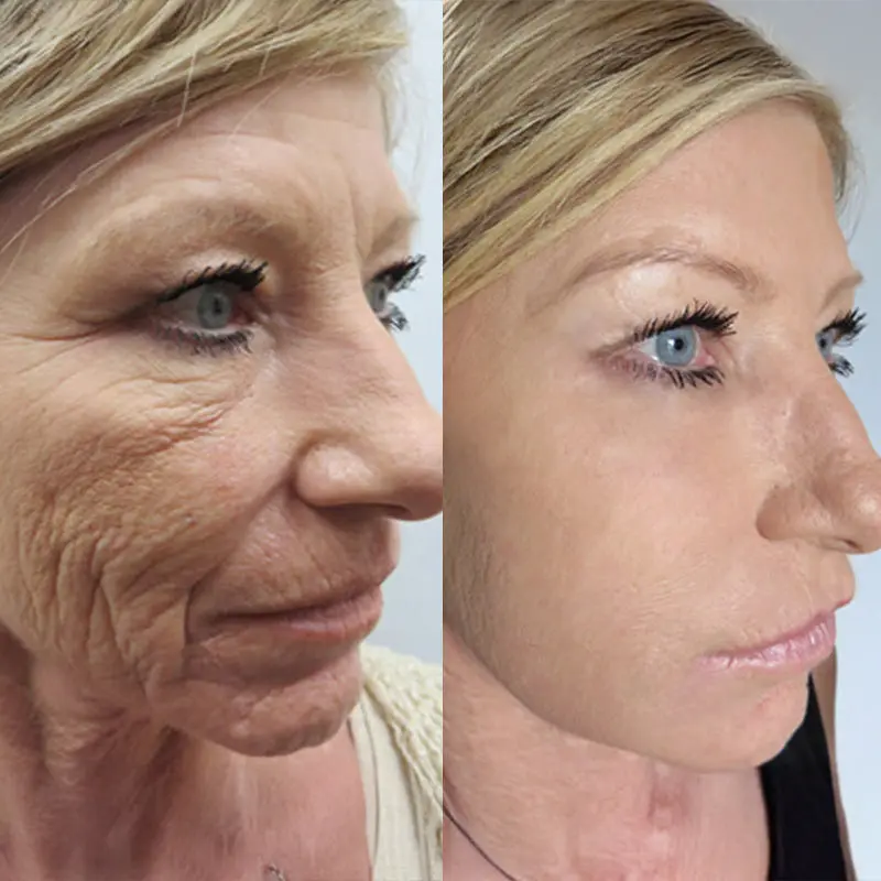 KUBOZN® GHK-Cu Microneedle Facial Patches