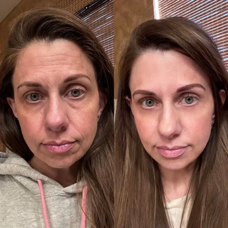 KUBOZN® GHK-Cu Microneedle Facial Patches