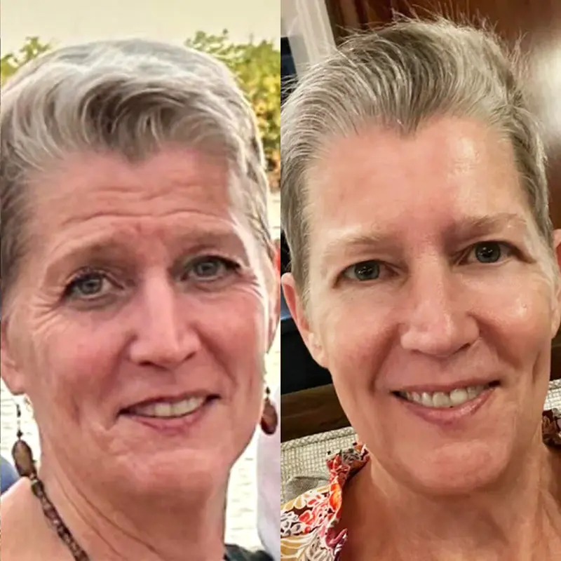 KUBOZN® GHK-Cu Microneedle Facial Patches