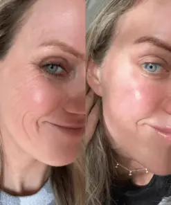 KUBOZN® GHK-Cu Microneedle Facial Patches