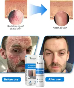KUBOZN® Magnesium Herbal Psoriasis Eczema Spray (FDA Certified 3-Minute Relief)
