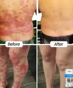 KUBOZN® Magnesium Herbal Psoriasis Eczema Spray (FDA Certified 3-Minute Relief)