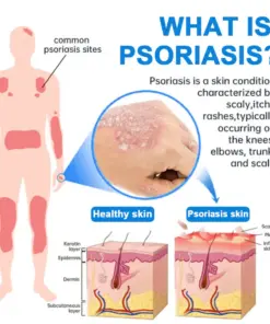 KUBOZN® Magnesium Herbal Psoriasis Eczema Spray (FDA Certified 3-Minute Relief)