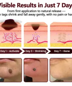 KUBOZN® OryzaDarts TAGGONE Patch Pain-Free Root-Level Removal Powered by Black Rice MicroDarts.