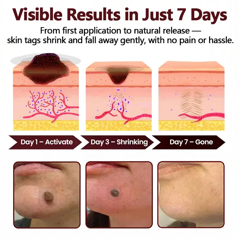 KUBOZN® OryzaDarts TAGGONE Patch Pain-Free Root-Level Removal Powered by Black Rice MicroDarts.