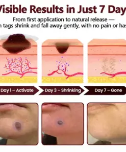 KUBOZN® OryzaDarts TAGGONE PatchPain-Free Root-Level Removal Powered by Black Rice MicroDarts.