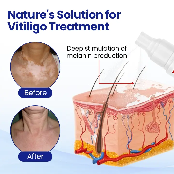 KUBOZN® Vitiligo Treatment Spray Visible Results in Weeks, 100 Natural Steroid-Free