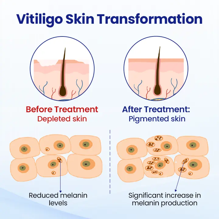 KUBOZN® Vitiligo Treatment Spray Visible Results in Weeks, 100 Natural Steroid-Free