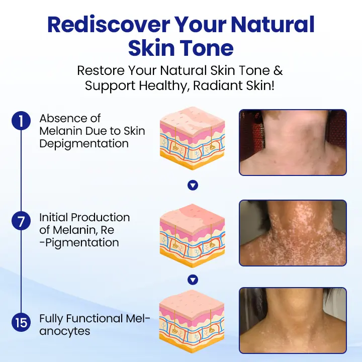 KUBOZN® Vitiligo Treatment Spray Visible Results in Weeks, 100 Natural Steroid-Free