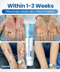 KUBOZN® Fragile Skin Repair Cream