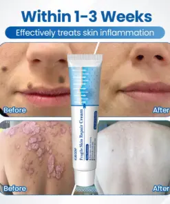 KUBOZN® Fragile Skin Repair Cream